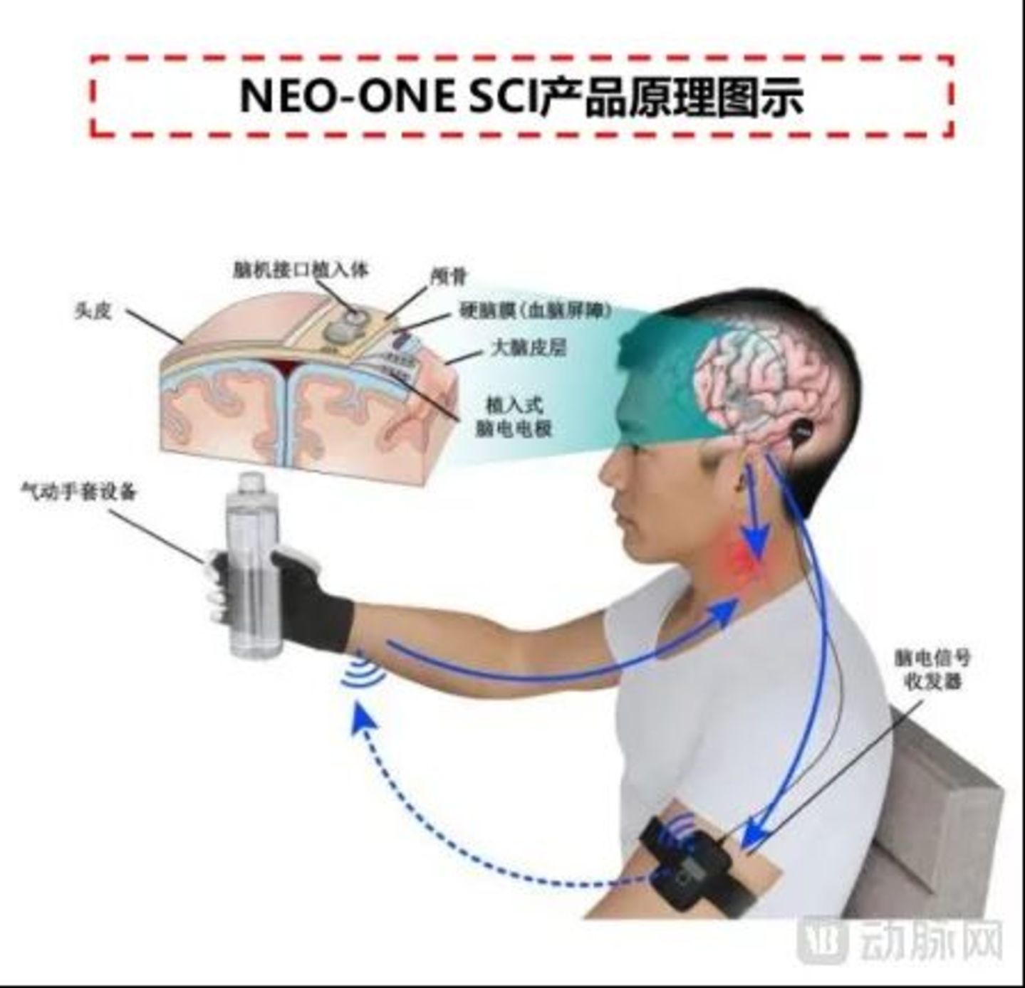 投资人拆解脑机接口:不是所有“技术领先”都值得下注 投资人拆解脑机接口:不是所有“技术领先”都值得下注