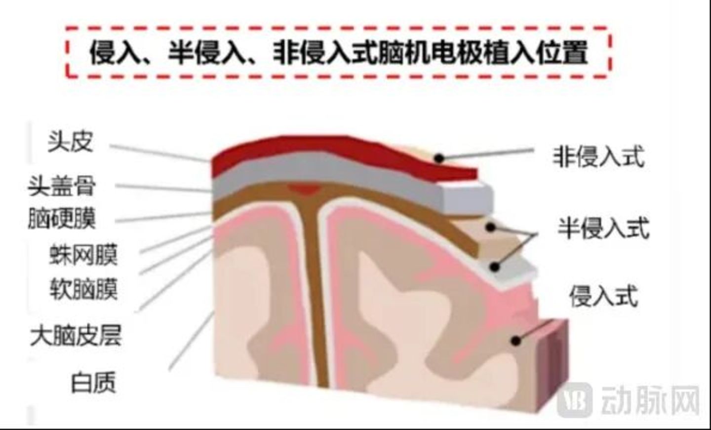  投资人拆解脑机接口：不是所有“技术领先”都值得下注